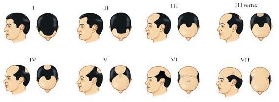 Alopecia androgénica masculina