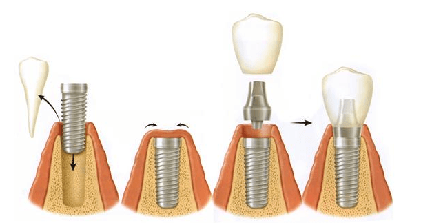 Cómo se Coloca un Implante Dental Paso a Paso